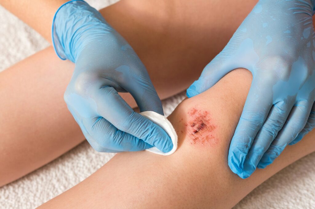 Injured leg wound knee with blood and doctor's hands in blue medical gloves treats a patient